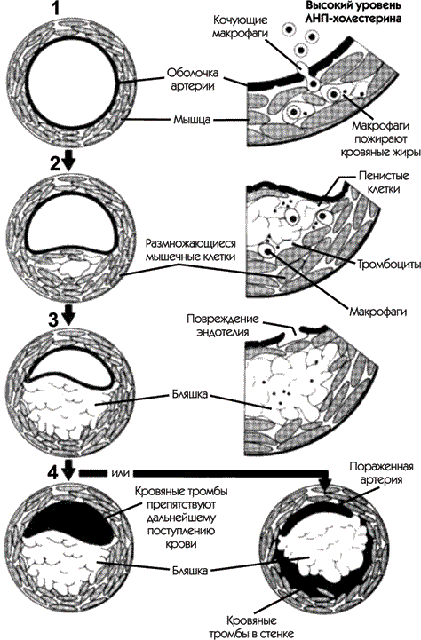Инсульт. Жизнь до и после - i_004.png