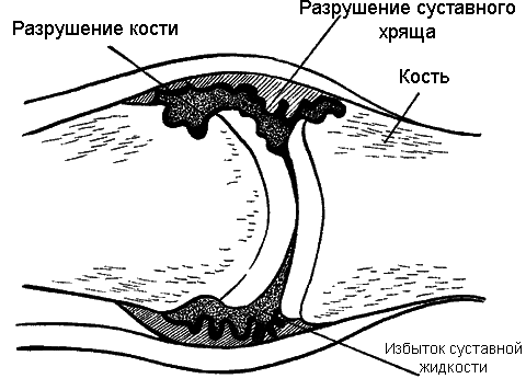 Массаж при артрите - _004.png