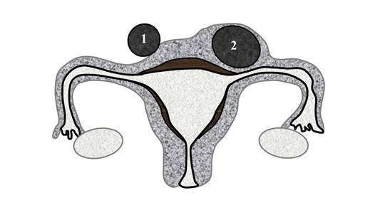 Миома матки – выход есть! - _5.jpg