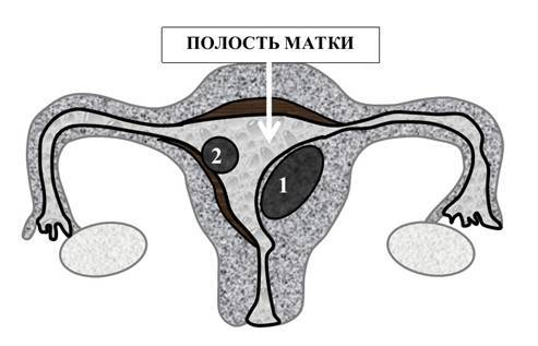 Миома матки – выход есть! - _6.jpg