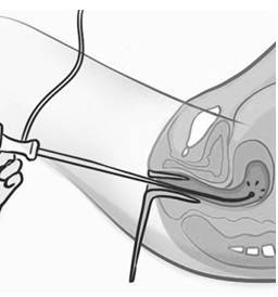 Миома матки – выход есть! - _7.jpg