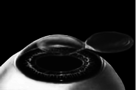 Лазерная коррекция зрения - i_005.png