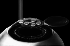 Лазерная коррекция зрения - i_006.png