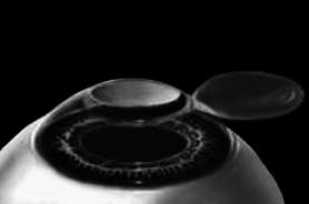 Лазерная коррекция зрения - i_007.png