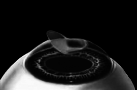 Лазерная коррекция зрения - i_008.png