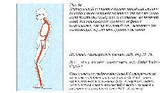 Болезнь Бехтерева - _6.jpg