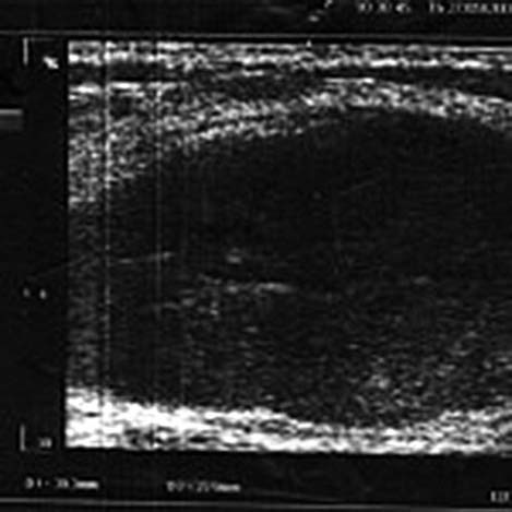 Мастопатия и гинекомастия - ris10.jpg