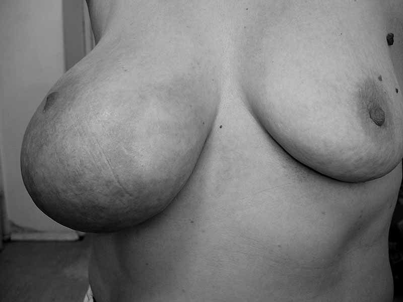 Мастопатия и гинекомастия - ris12.jpg