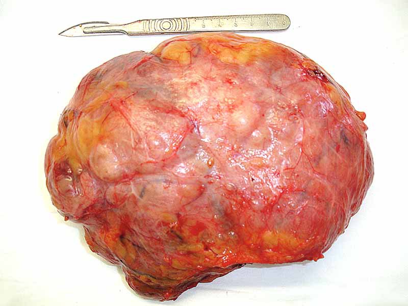 Мастопатия и гинекомастия - ris14.jpg