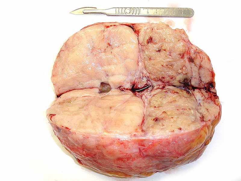 Мастопатия и гинекомастия - ris15.jpg