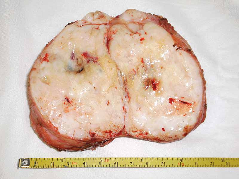 Мастопатия и гинекомастия - ris21.jpg